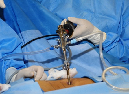 Disc Decompression Surgery