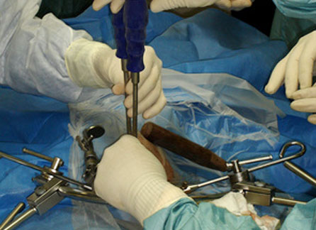Disc Replacement Surgery